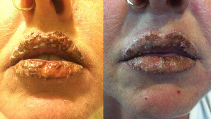 Jane Bildsøe fik ødelagt læber af permanent make-up Kontant | DR
