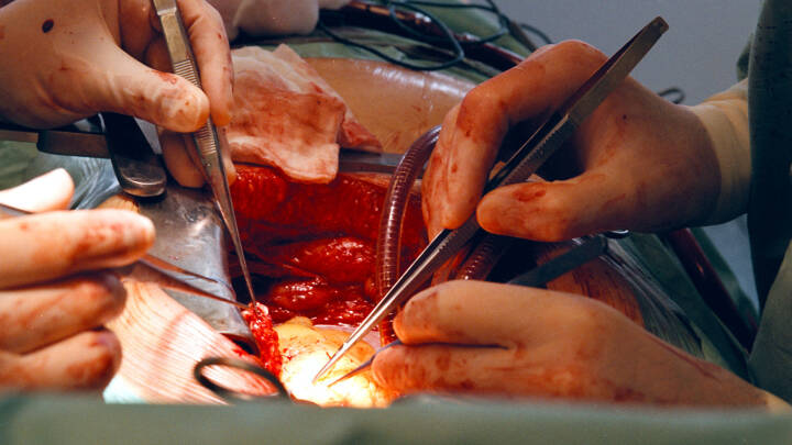 Transplantation af grisehjerte til et menneske
