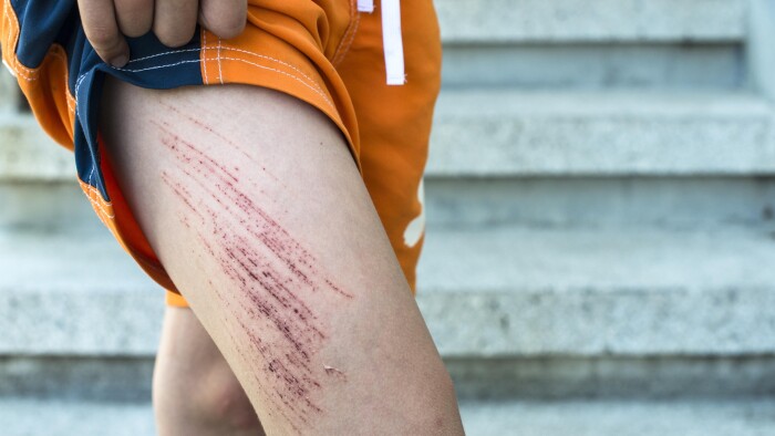 Brandsår, rifter og bid: Sådan heler du dine sår bedst | Kroppen | DR